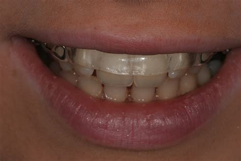 Effortless Alignment: A Comprehensive Review of Magic Dental Braces
